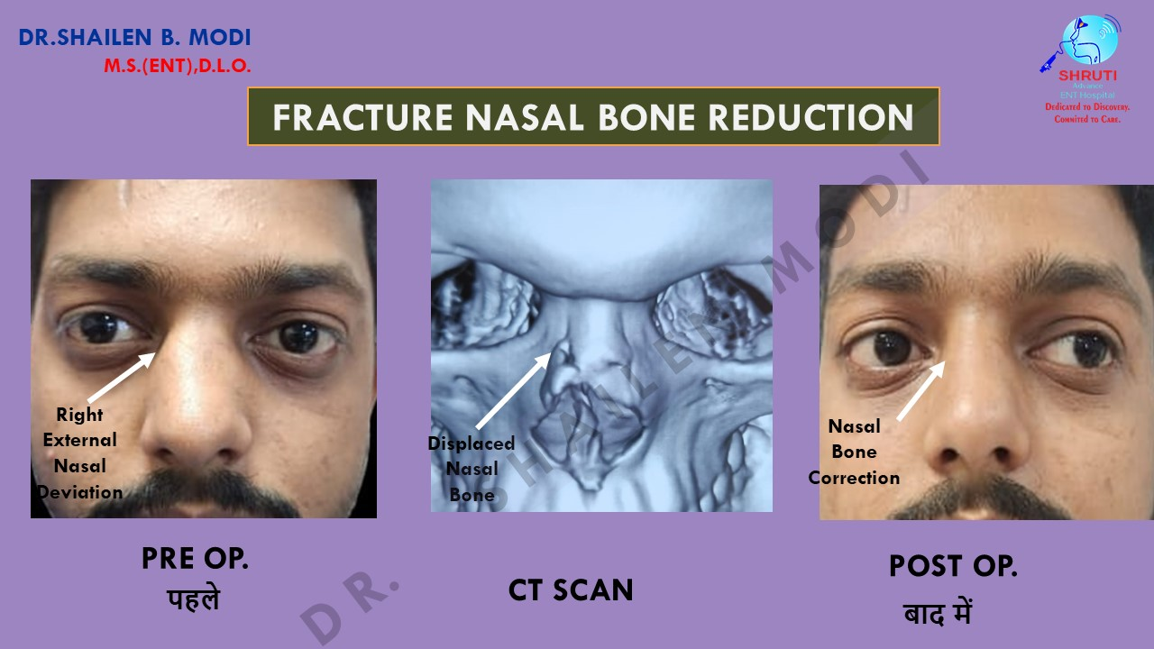 Nasal Bone Fracture Reduction