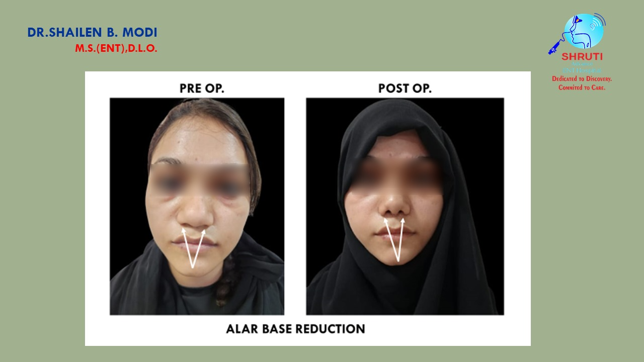 Septorhinoplasty Surgery