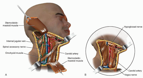 Radical Neck Dissection Surgery