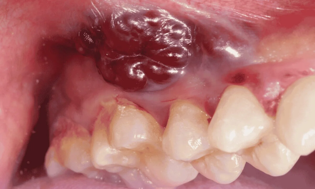 Oral Cavity Cancer Treatment