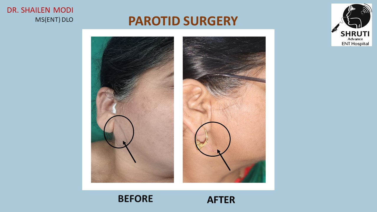 Parotidectomy Surgery
