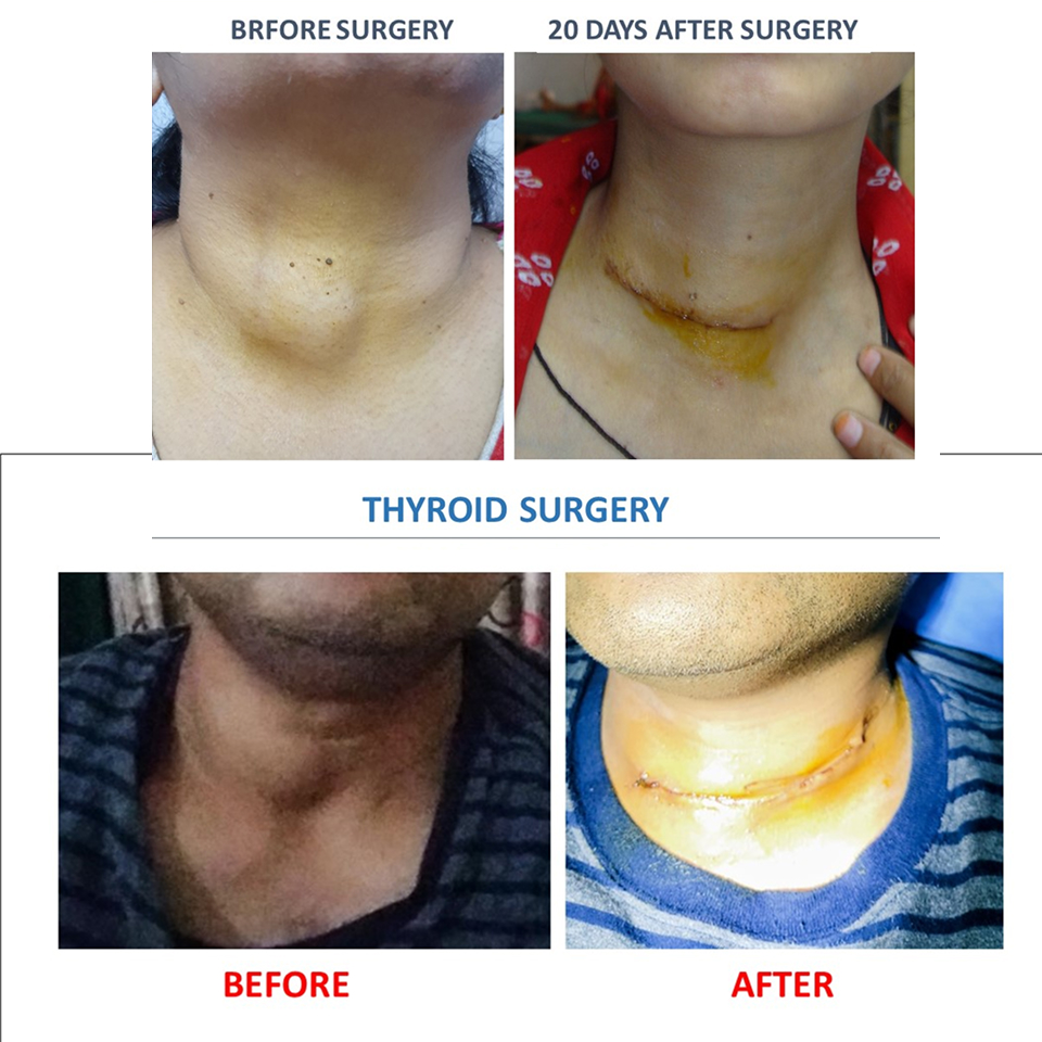 Thyroidectomy Surgery